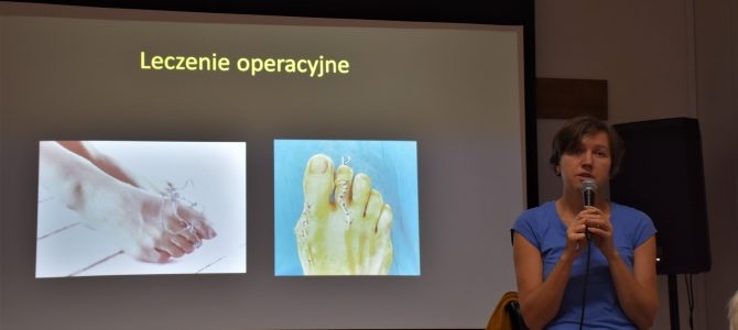 Paluch koślawy – hallux valgus